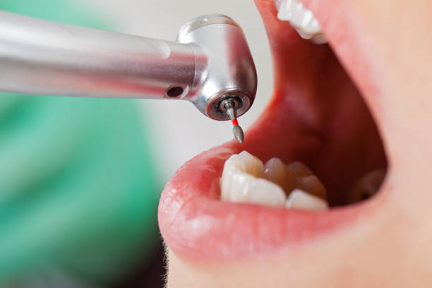 Best Chipped Tooth Repair Near Me  in Alta Sierra, CA